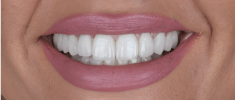 Smile Makeover After