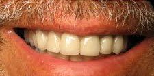 After Whitening