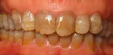Before Whitening